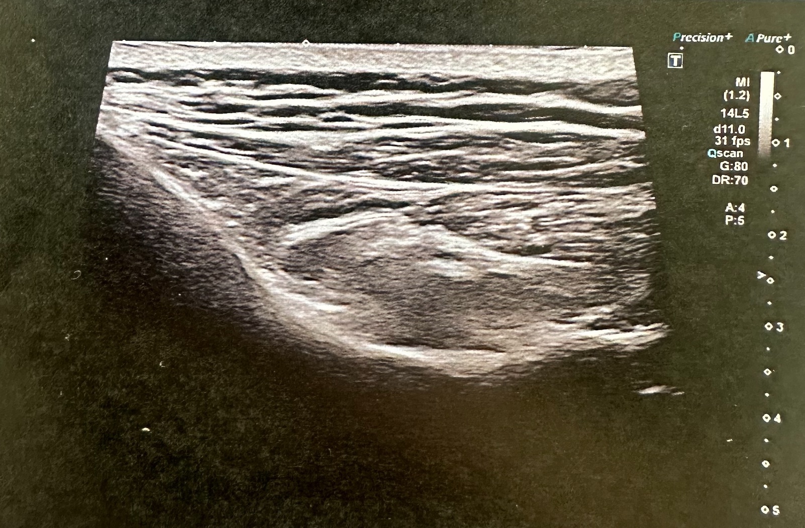 Echographie tendinite au coude