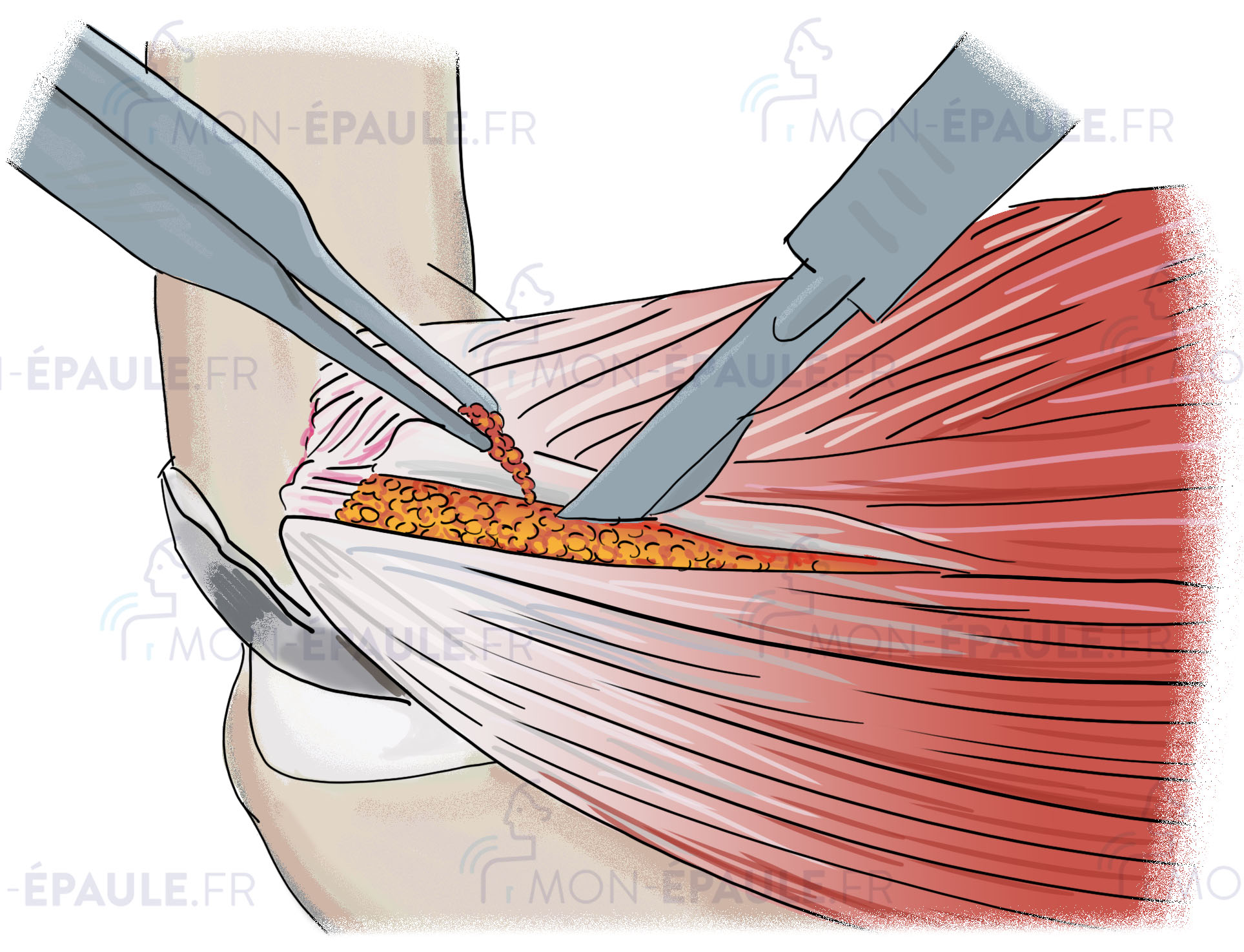 chirurgie sur tendinite au coude