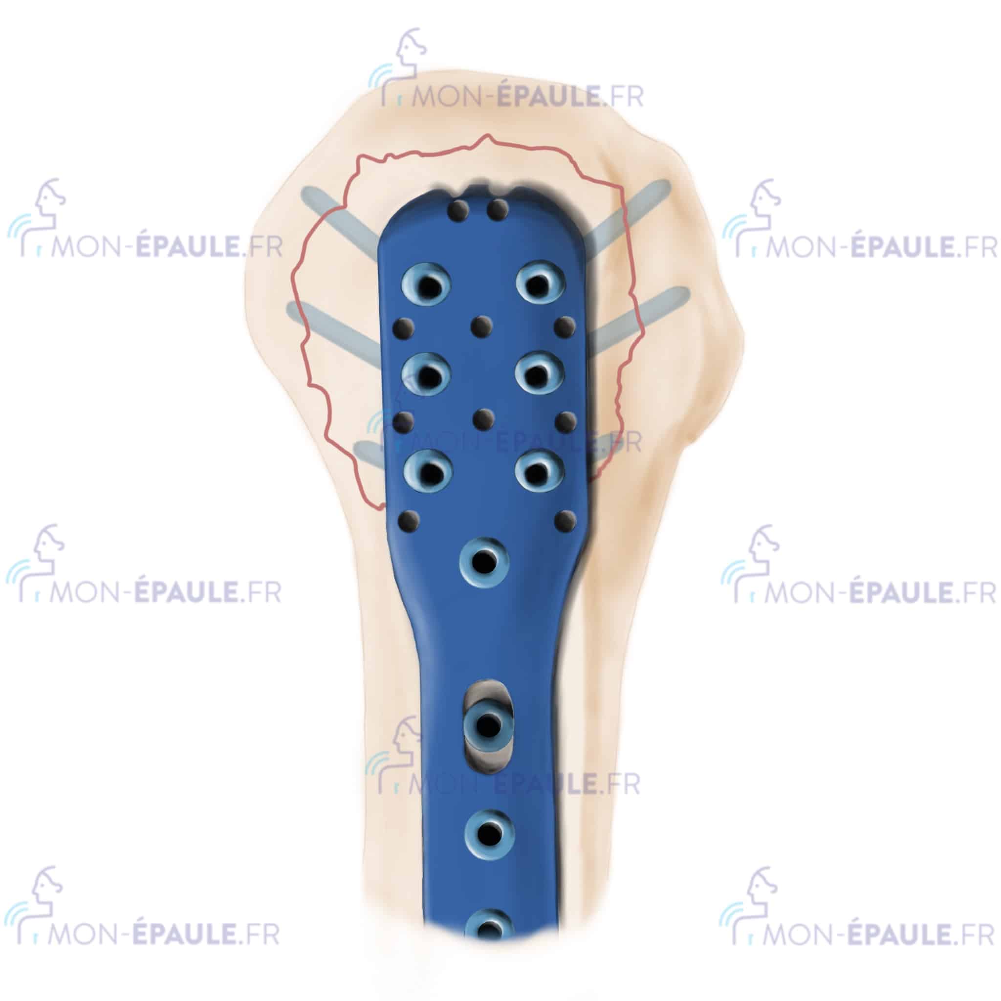 Plaque à vis sur une fracture de la tête humérale