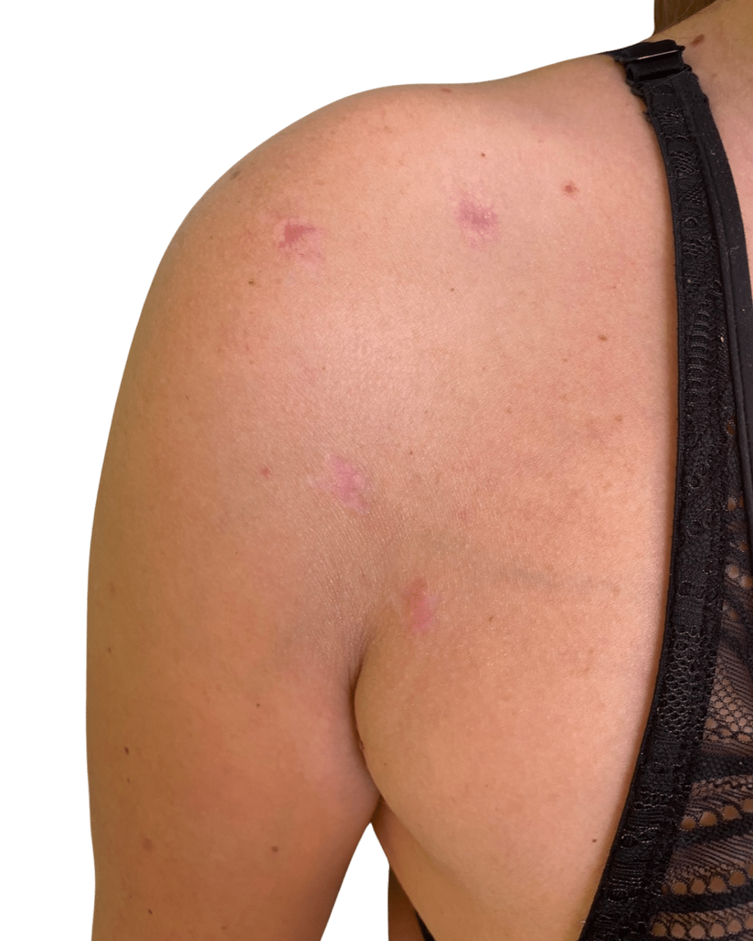 cicatrices après butée arthroscopique (5 mini incisions)