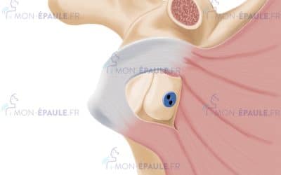 La butée d’épaule sous arthroscopie : l’intervention de référence contre les luxations récidivantes