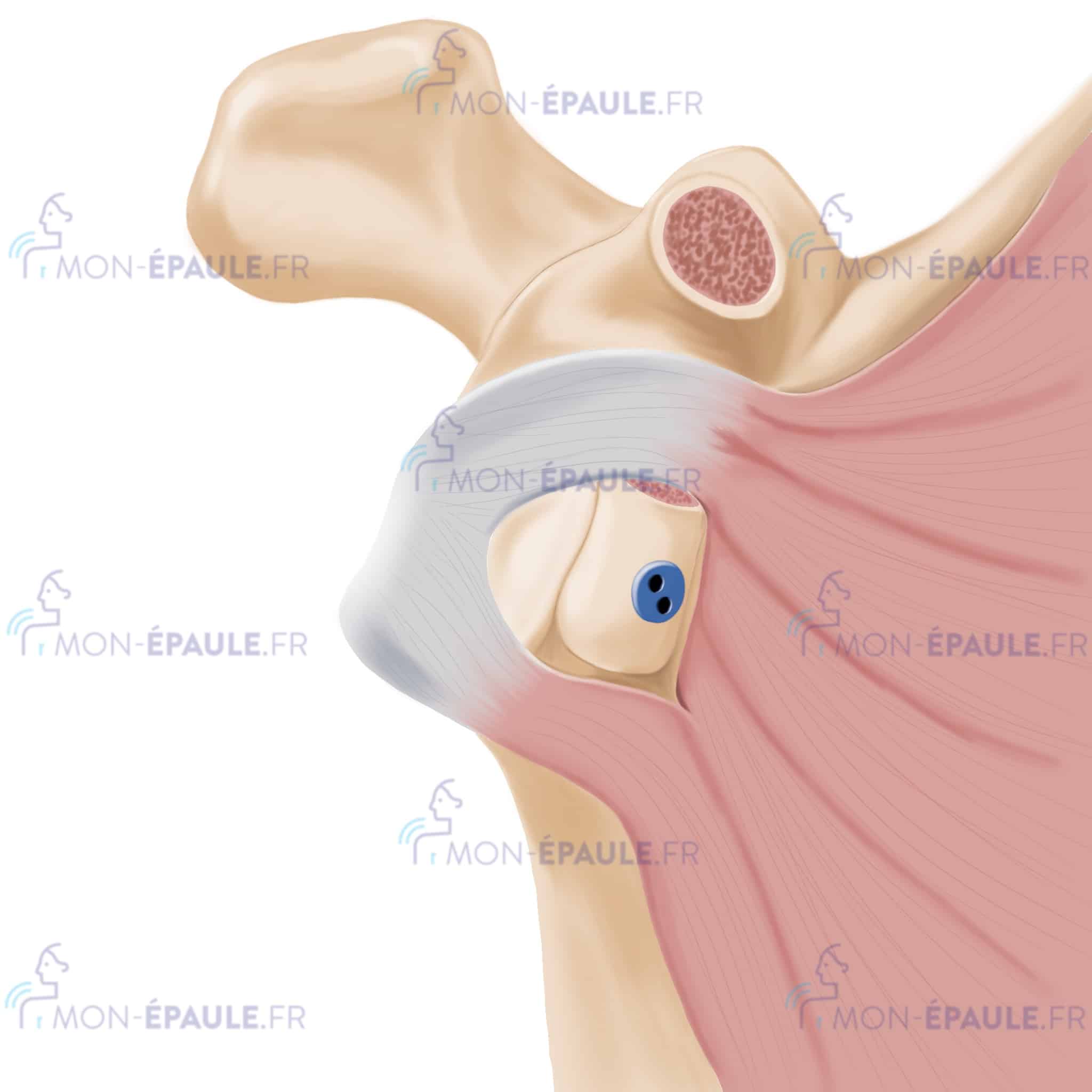 fixation définitive de la butée arthroscopique à l’omoplate par l’endobouton