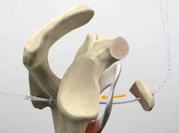 Mise en place de la butée d'épaule sous arthroscopie