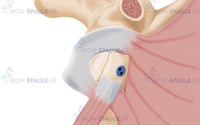 La butée d’épaule sous arthroscopie : l’intervention de référence contre les luxations récidivantes