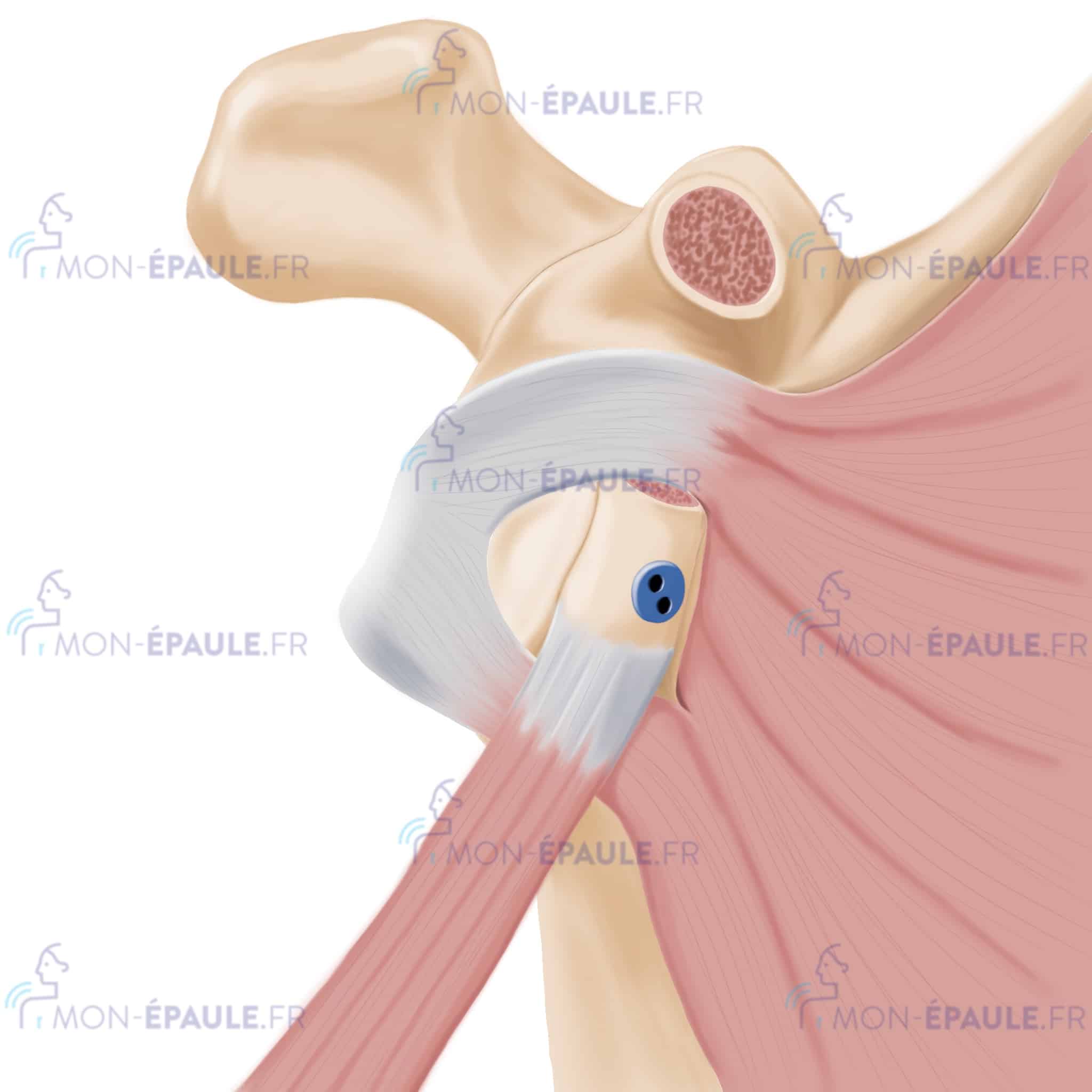 fixation définitive de la butée arthroscopique à l’omoplate par l’endobouton